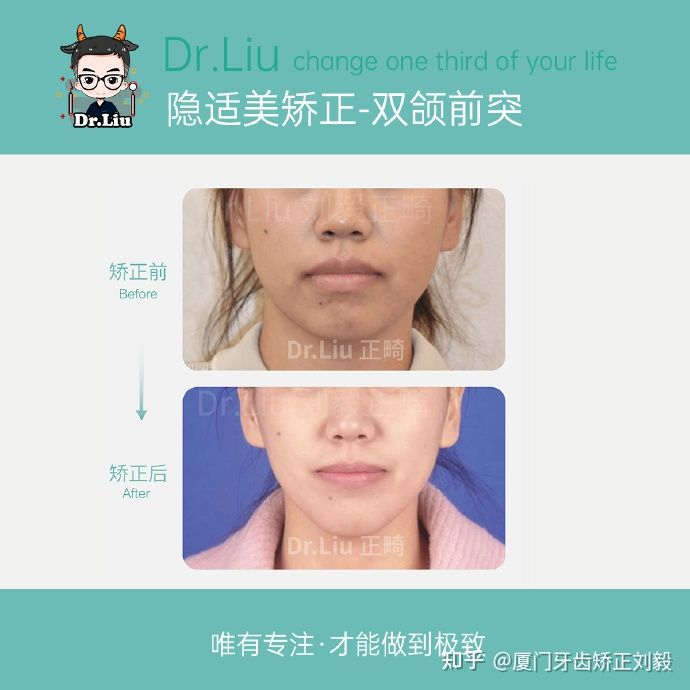 下嘴唇厚且外翻牙齿矫正,深覆合牙齿矫正嘴凸