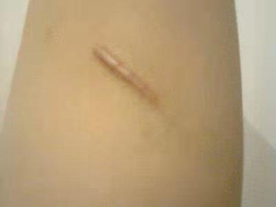 原来疤痕处感染化脓了怎么处理,刚刚形成的疤痕疙瘩怎么治疗