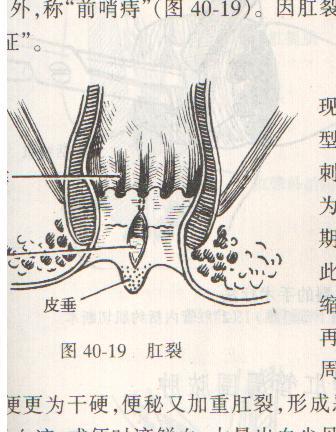“医生，我肛门里长出了小尾巴，是啥东西？”这5种情况了解下