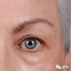 景甜修复后的双眼皮多宽,景甜修复之后的双眼皮是多宽