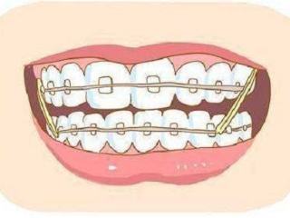 牙齿矫正结束戴保持器怎么佩戴,四十岁做牙齿矫正终身佩戴保持器
