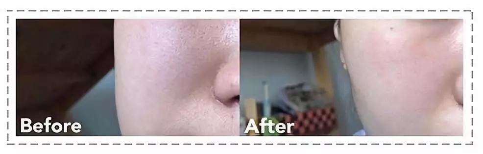 毛孔粗大最好的方法目前最有效的,毛孔粗大怎么缩小自然方法