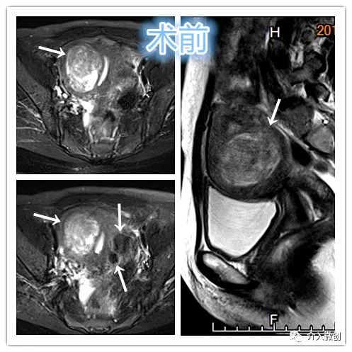 子宫肌瘤介入栓塞术排出黄水,子宫肌瘤介入消融治疗