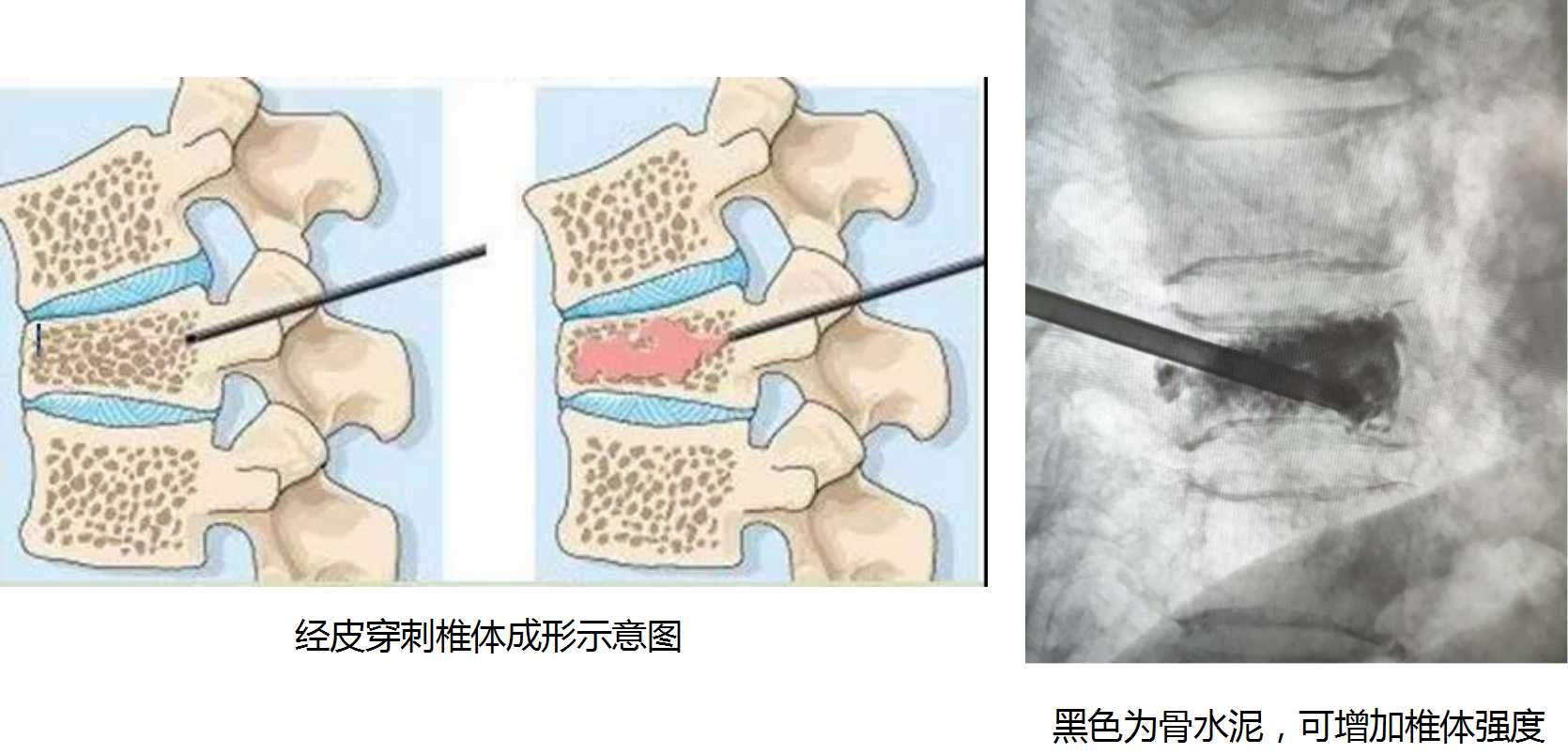 70岁老人腰骨折需要手术么,70岁老人腰椎骨折是保守还是手术
