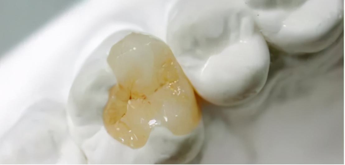 牙齿残根不疼不拔好吗,牙齿残根不疼