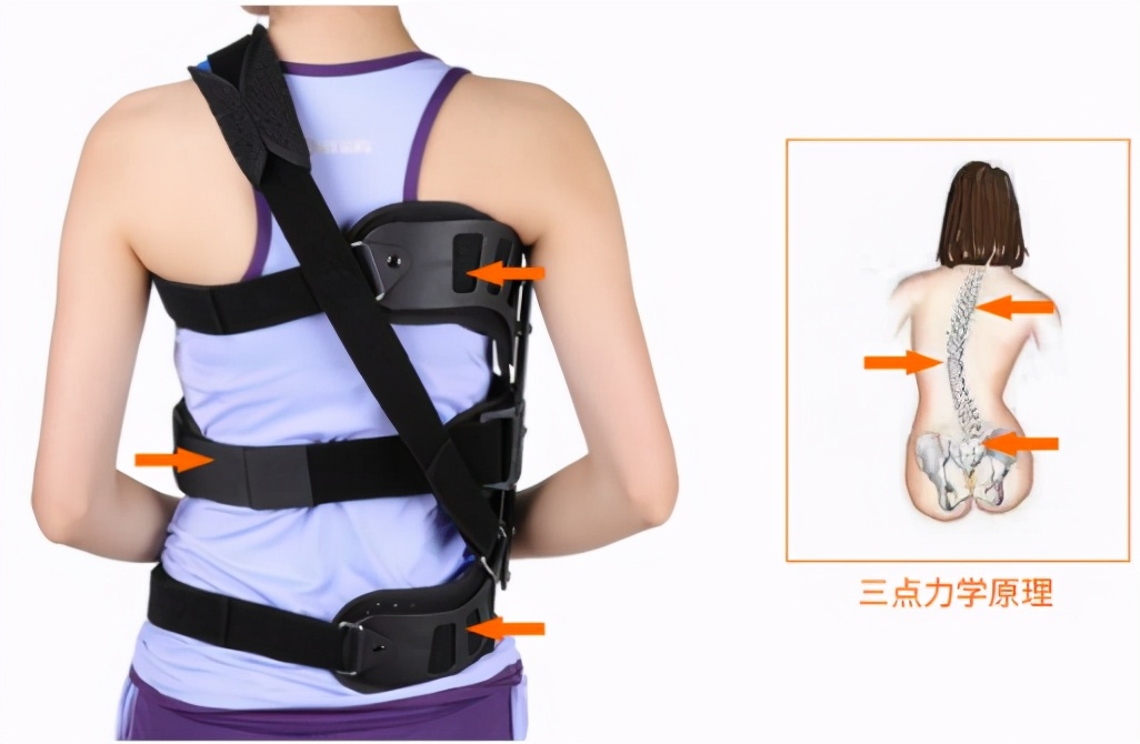 脊柱侧弯的矫正方法之支具治疗