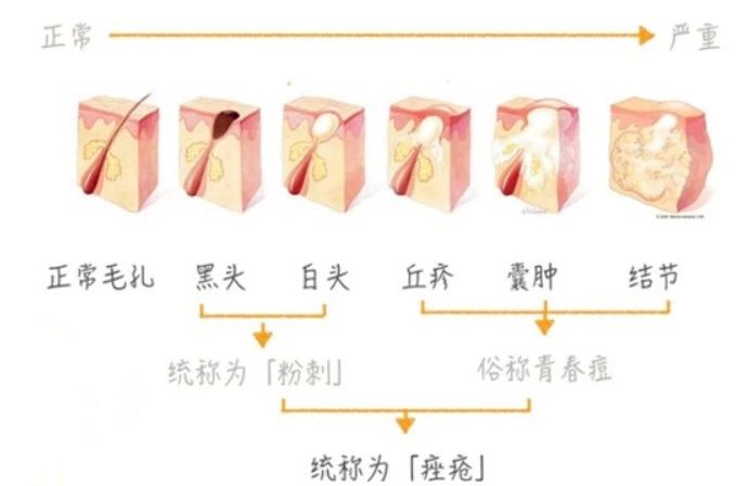 为什么我们背后会起痘痘,长痘痘是什么原因祛痘方法有哪些