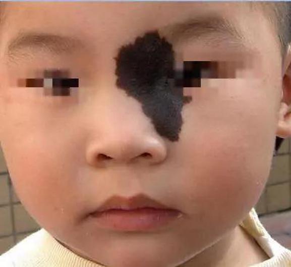 去黑毛痣最好的治疗方法,黑毛痣怎么治疗效果才好呀