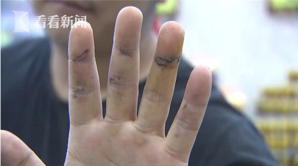 男子手指被刺穿去医院,男子手划破去医院