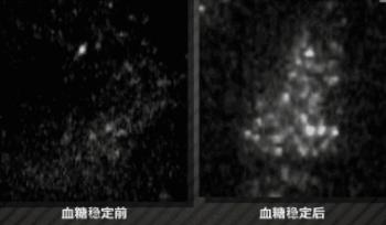 有没有什么好的方法治糖尿病呢,五种治疗糖尿病的新方法