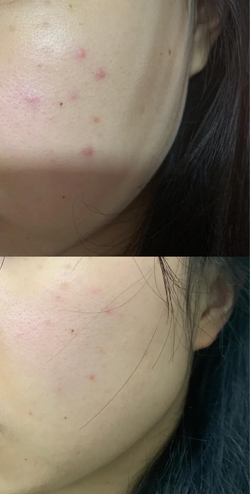 公认最好的祛痘印产品,祛痘印痘坑用什么产品最好