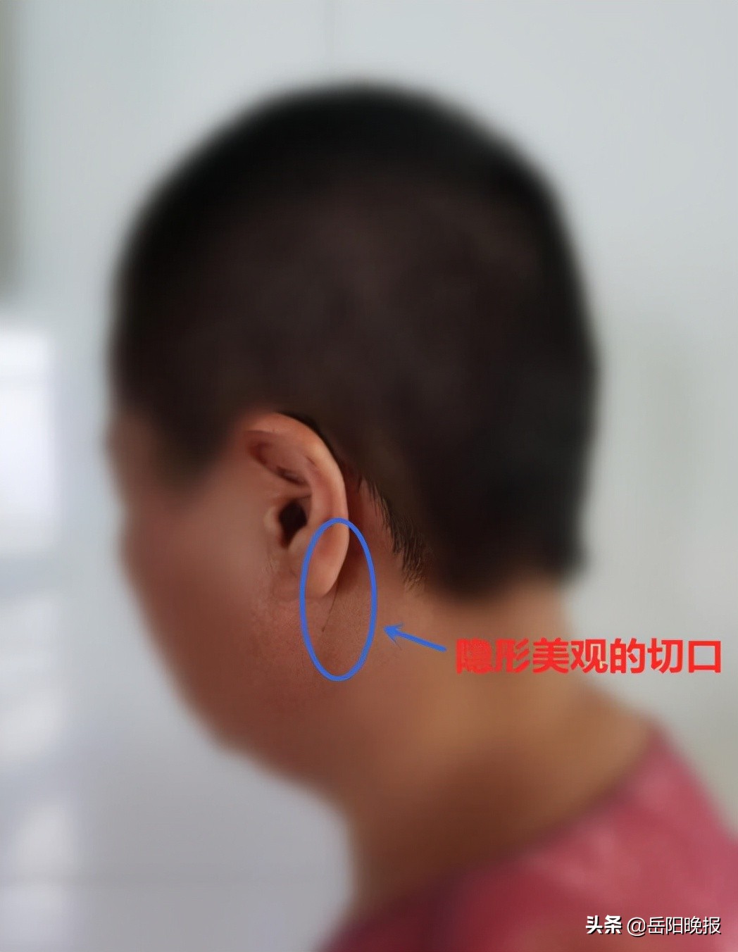 突破！岳阳市中心医院神经外科改良粗大椎动脉压迫面神经悬吊术