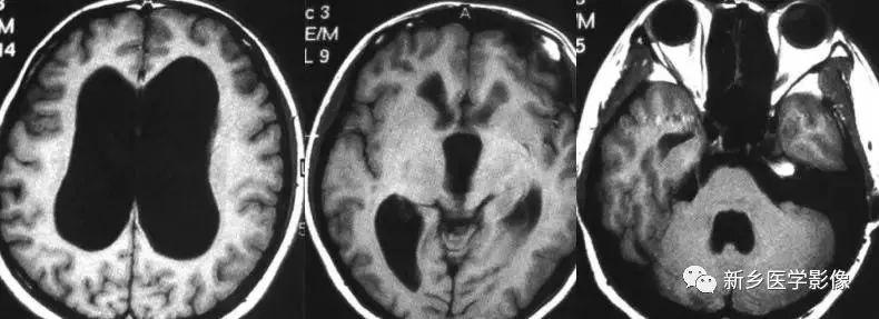 什么引起成人脑室扩大,哪些病可以导致左侧脑室增宽