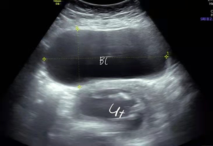 孕妇尿潴留怎么治疗才能断根,孕妇非梗阻性尿潴留