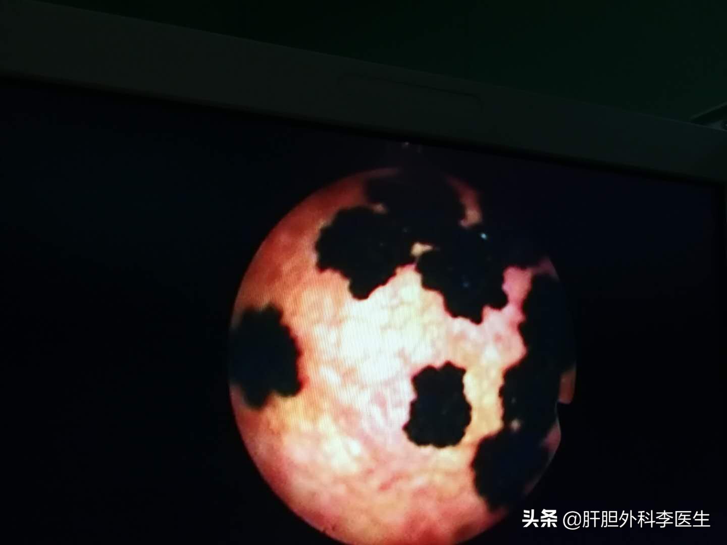 胆囊结石92老人建议做手术吗,九十多岁的老人胆管结石怎么办