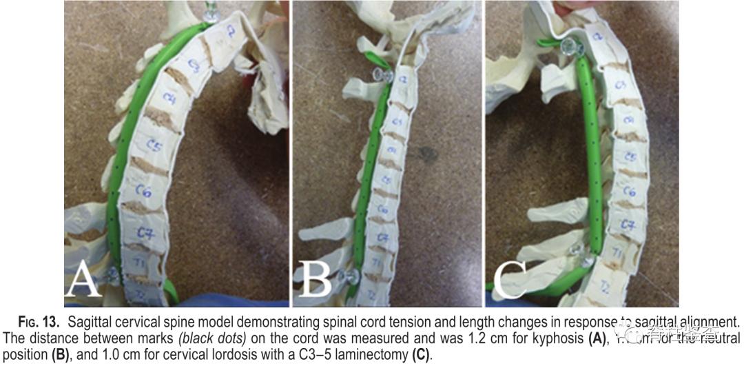查出颈椎多节病变,颈椎生理曲度稍变直能恢复吗