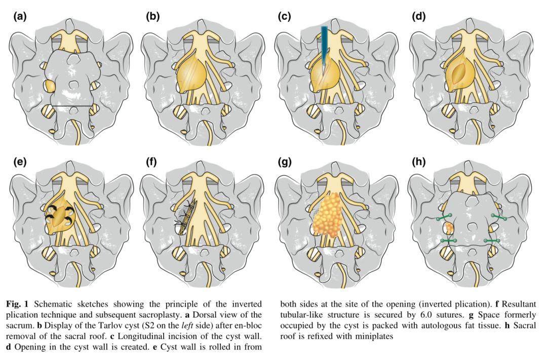 骶管蛛网膜囊肿怎么治疗,有症状的骶管囊肿检查得出来吗