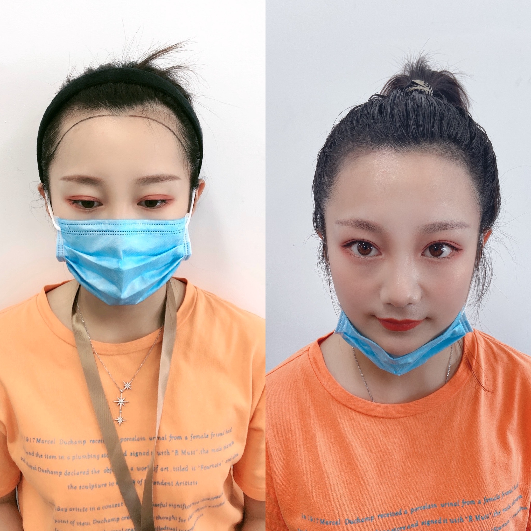 欧婷儿生发发际线靠谱吗,欧婷儿发际线调整方案