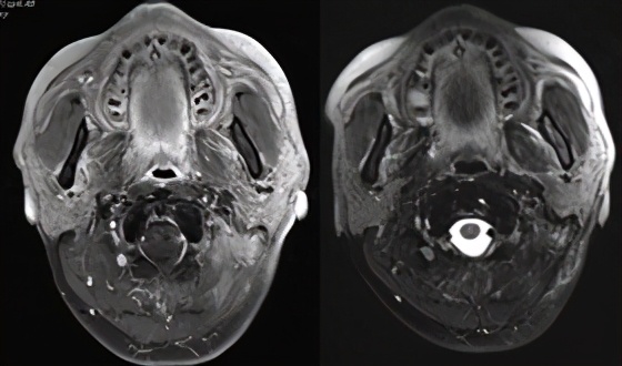 pd-1抑制剂适用的肿瘤类型,pd-1抑制剂能用于癌症晚期么