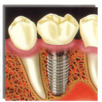 假牙价格一览表图片,假牙种类及价格表图片