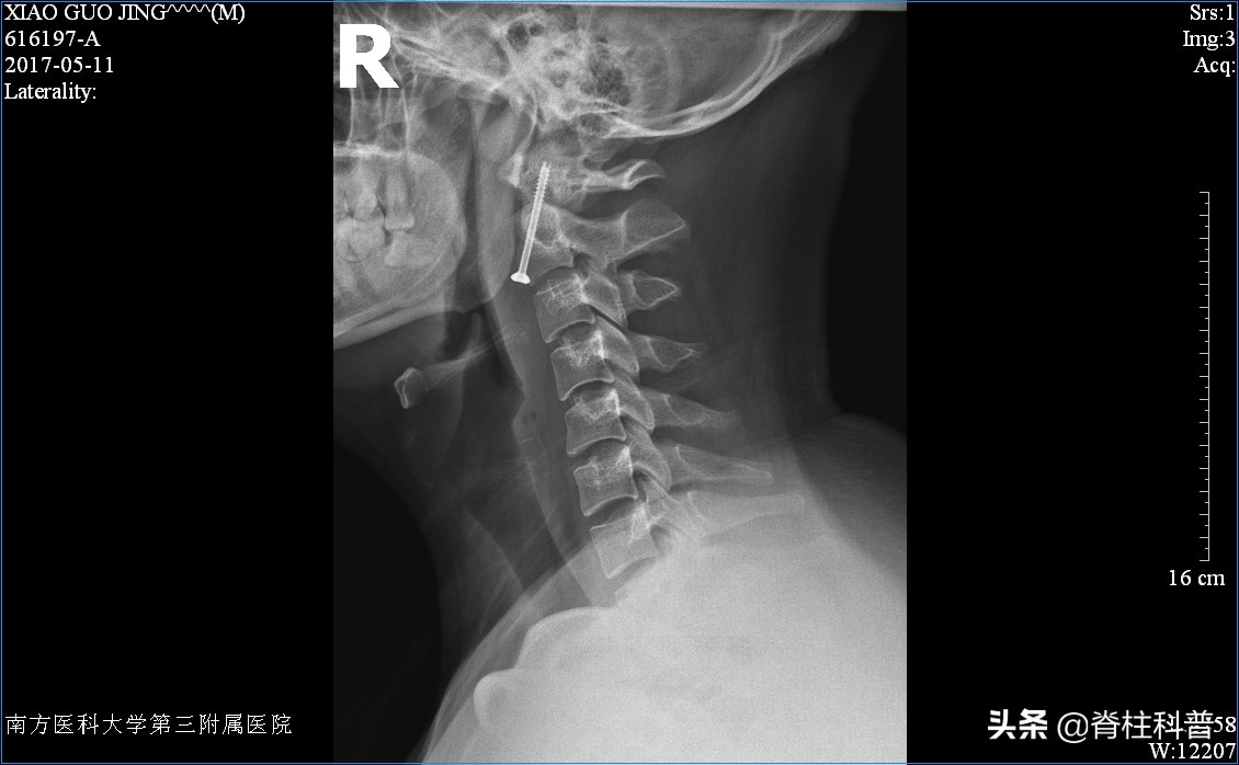 逃过了医院手术的一劫,halovest支架