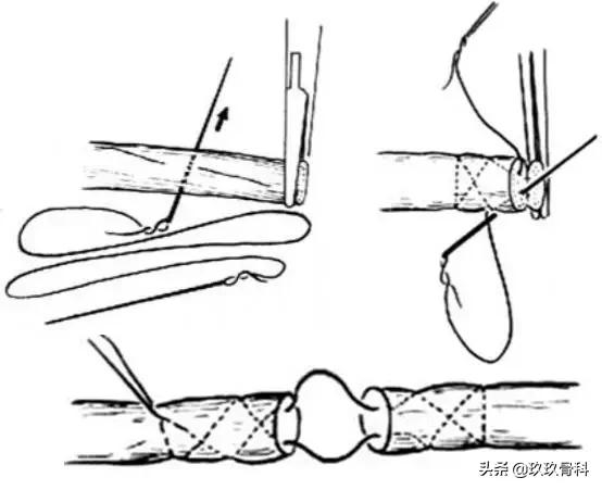 跟腱断裂的确诊方法,超详细跟腱断裂的诊断与治疗