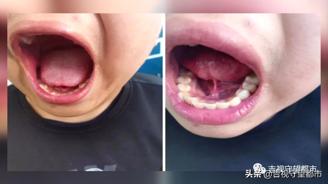 孩子说话有点大舌头要矫正吗,孩子讲话有点大舌头应该看什么科