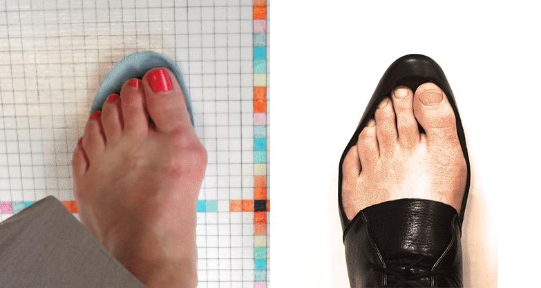 大脚骨是骨质增生吗,为什么会有大脚骨这种脚型