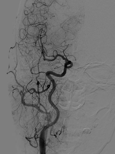 Tubridge®治疗多发性动脉瘤