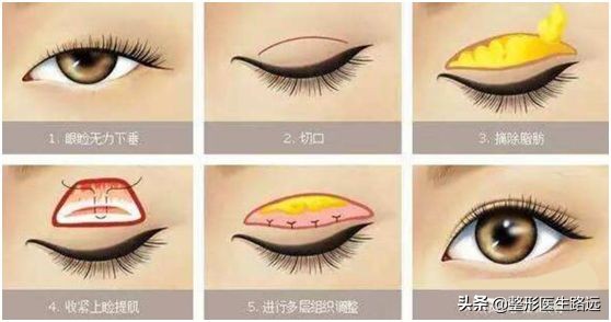 西安哪家双眼皮做的好,西安医美整形双眼皮