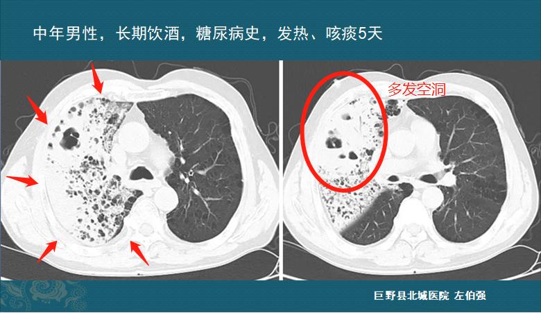 细菌性肺炎吐痰颜色加深,肺炎吐痰粉色需要治疗吗