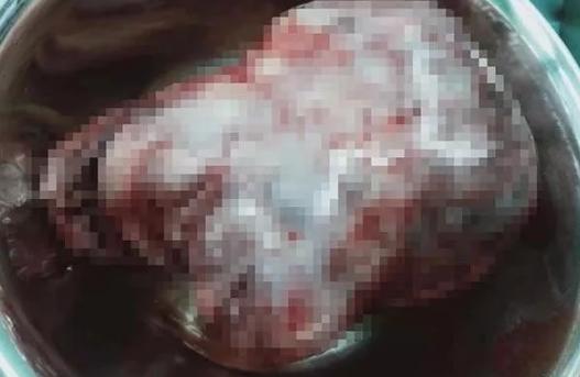 未婚未育女孩腹痛18小时，原来是比拳头还大的子宫肌瘤作怪