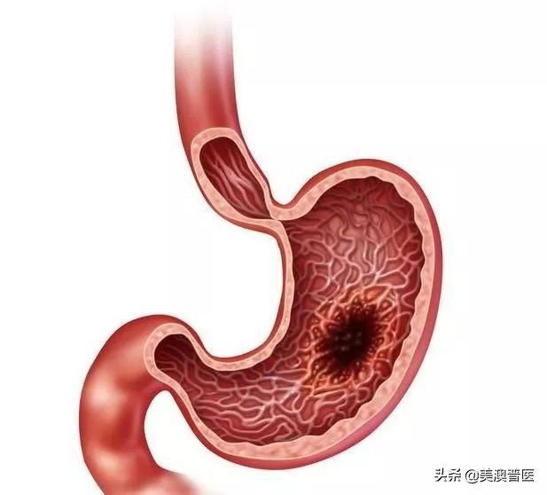 六个胃癌前病变,得了胃病不可再忽视