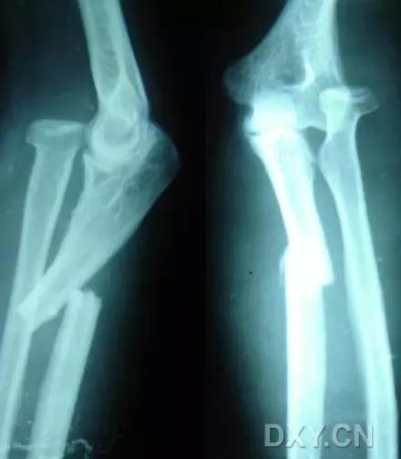 特殊骨折类型,特殊骨折体征