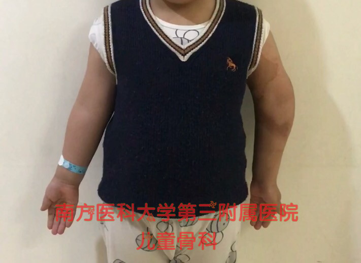 左前臂骨折后的康复训练,手臂外翻或内翻该怎么矫正