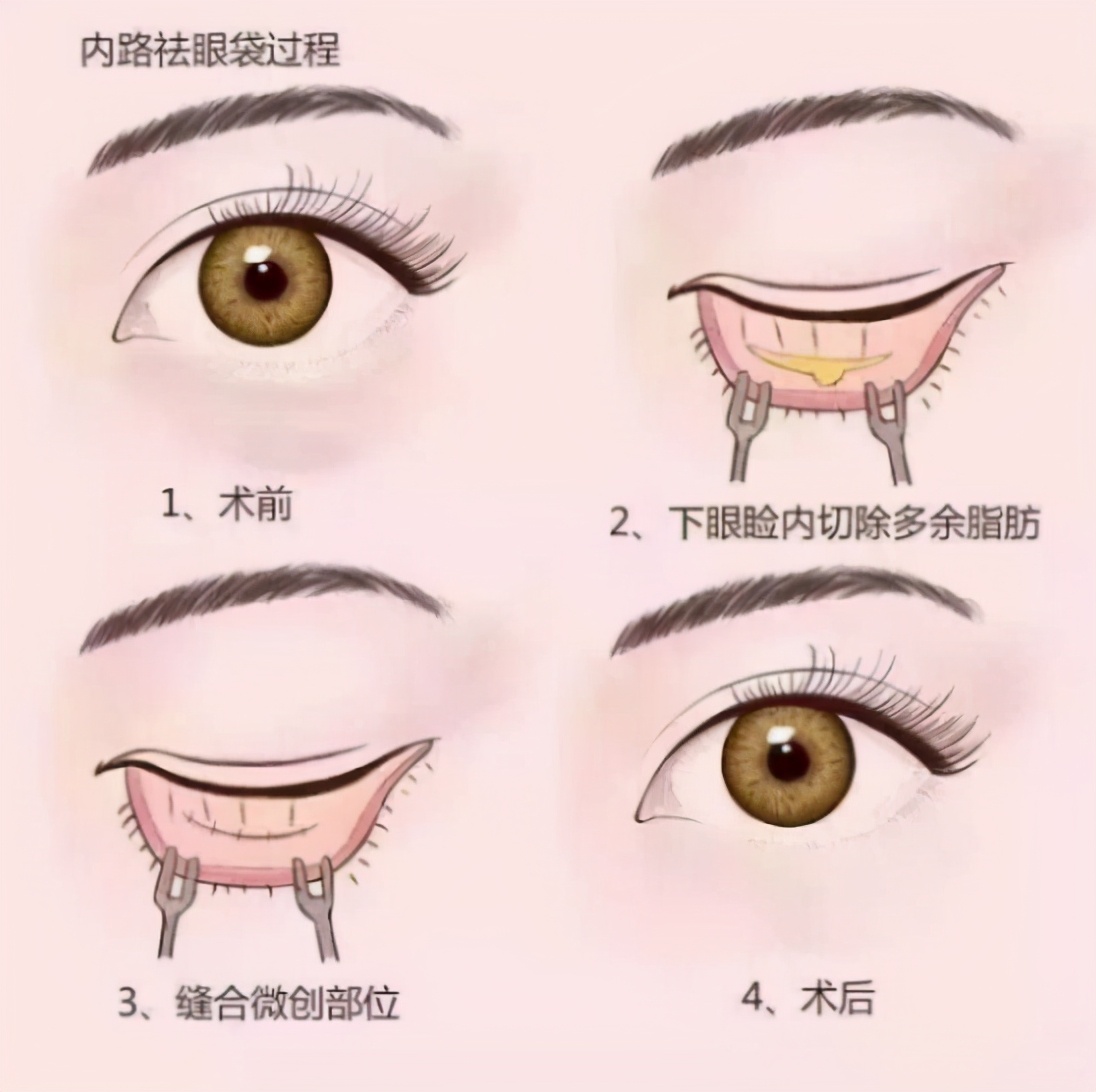 黑眼圈眼袋的最有效的解决方法,眼袋和黑眼圈长一起如何遮住
