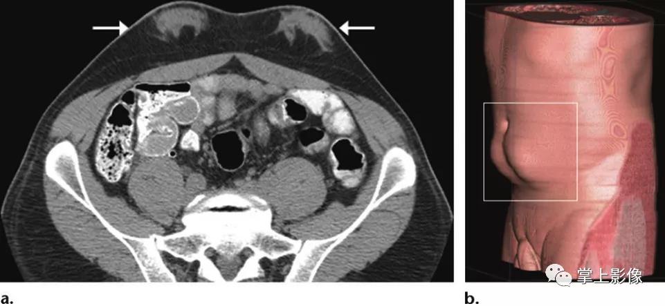 腹壁病变诊断思路,腹部影像诊断读片入门视频