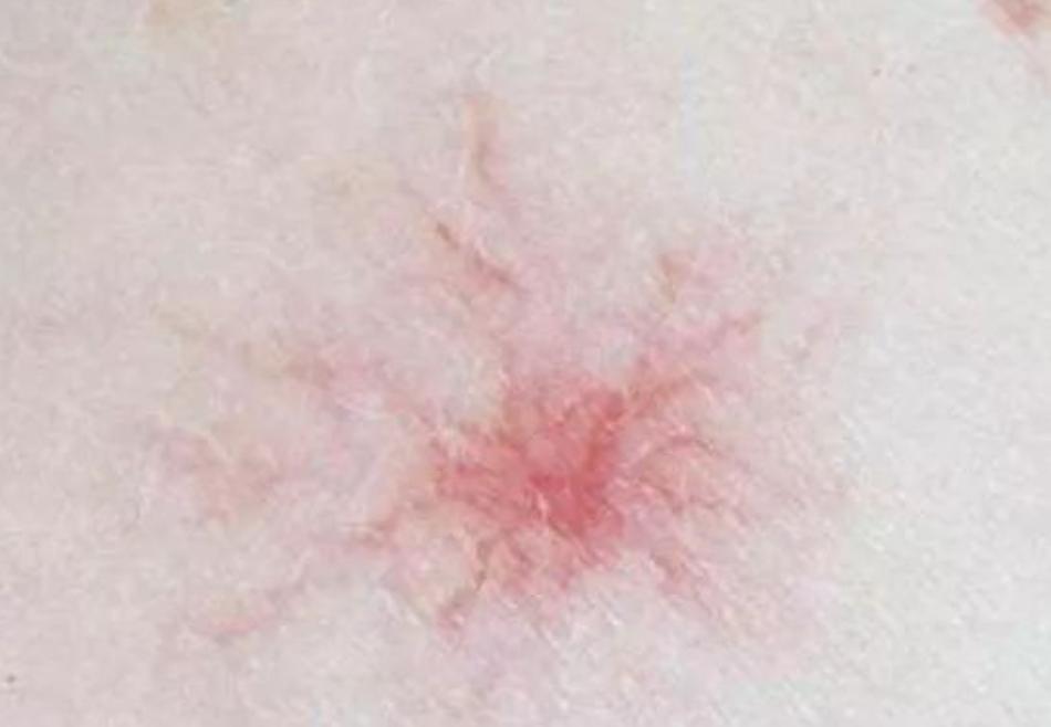 身上的痣自己会消除吗,身上的痣能随便去掉会死吗