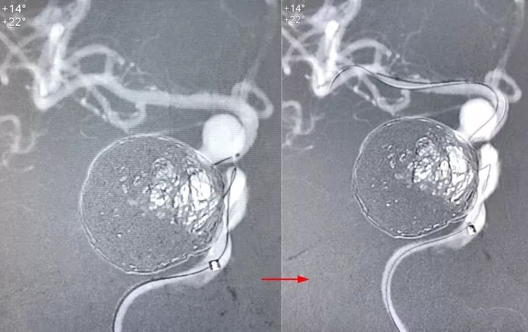 国外怎么治疗动脉瘤,全世界颅内动脉瘤最佳的治疗