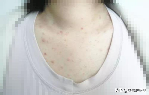 【认真的聊聊马拉色菌毛囊炎！！】