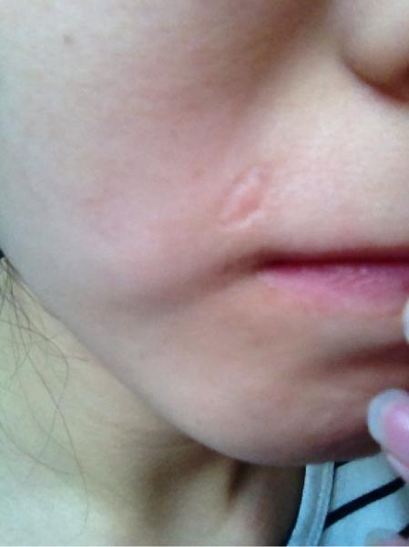 点痣留下了疤痕怎么祛,点痣留下的疤痕怎么消除最有效