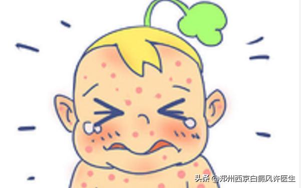 白癜风泡温泉用什么遮盖,白癜风患者能用什么中药泡澡