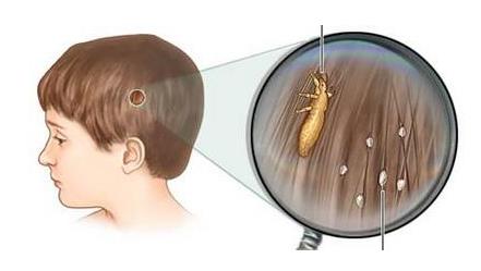 去头发虱子与虱子卵最有效方法,去除头上虱子和虱子卵最好小窍门