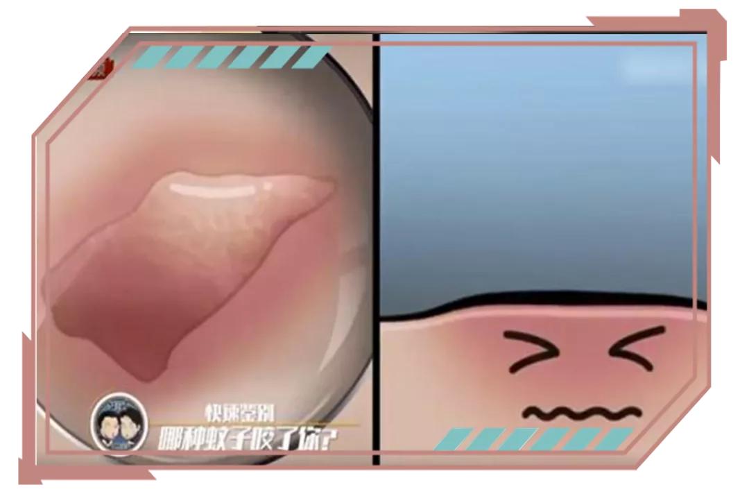 同样是被咬，为啥你的包又痒又大？