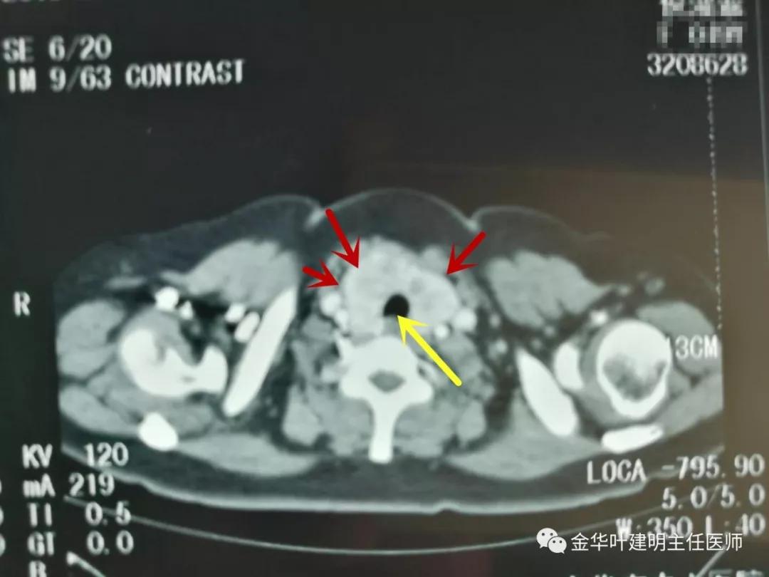 甲状腺肿瘤超大,胸骨后甲状腺肿病情是否很严重