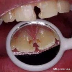 门牙马上要掉了怎么办,门牙连根掉了时间长还能安上吗