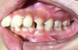 8岁的孩子能做牙齿矫正吗,7岁孩子矫正牙齿早吗