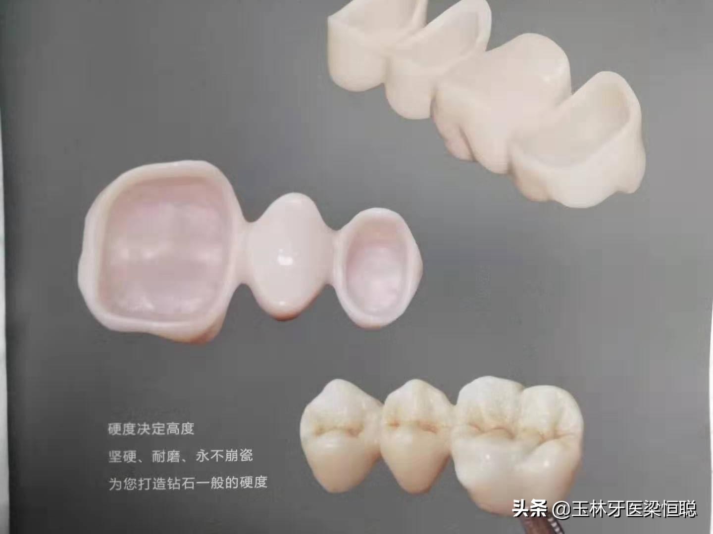 全瓷牙和烤瓷牙冠的区别,烤瓷牙和全瓷牙冠有什么区别