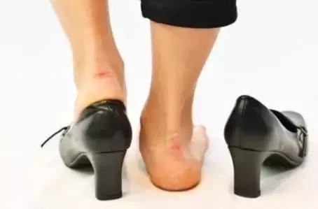 鞋子买小了磨脚怎么办,鞋子买小了挤脚不给换