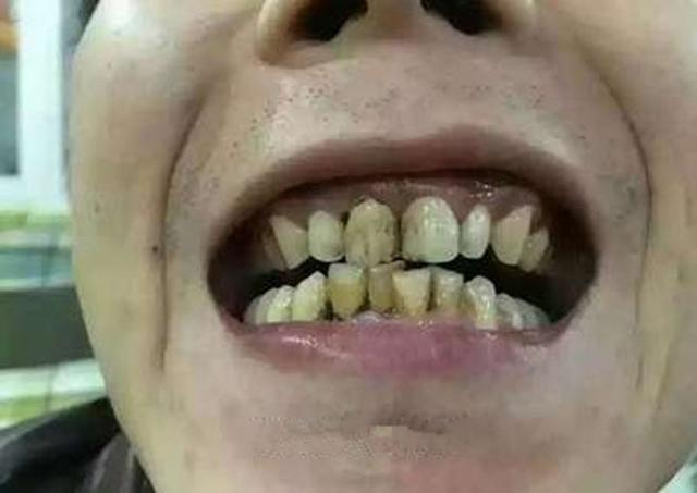 洗完牙还是黄牙怎么变白牙,牙黄怎么刷牙都不掉怎么办